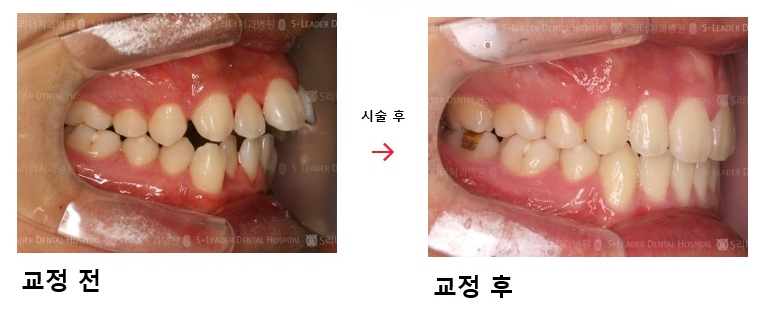 광진구교정치과, 구강상태에 맞는 방법으로 관련 이미지 2