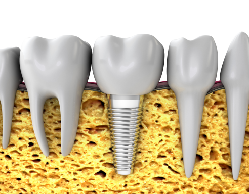 3 Things to Check When Considering Implants at Sagajeong Dental Clinic image 2