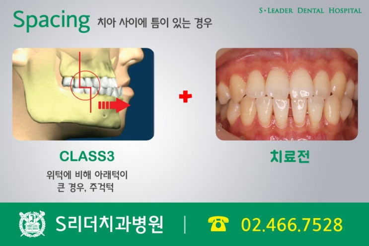 군자동치과에서 치아교정 주인공은 나야나 관련 이미지 6