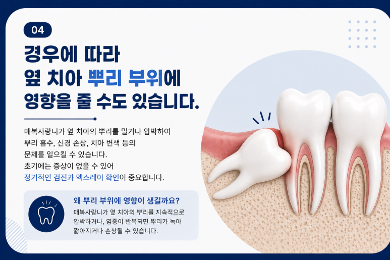 건대입구치과, 매복 사랑니가 옆 치아에 영향을 줄 수도 있을까요? 관련 이미지 7