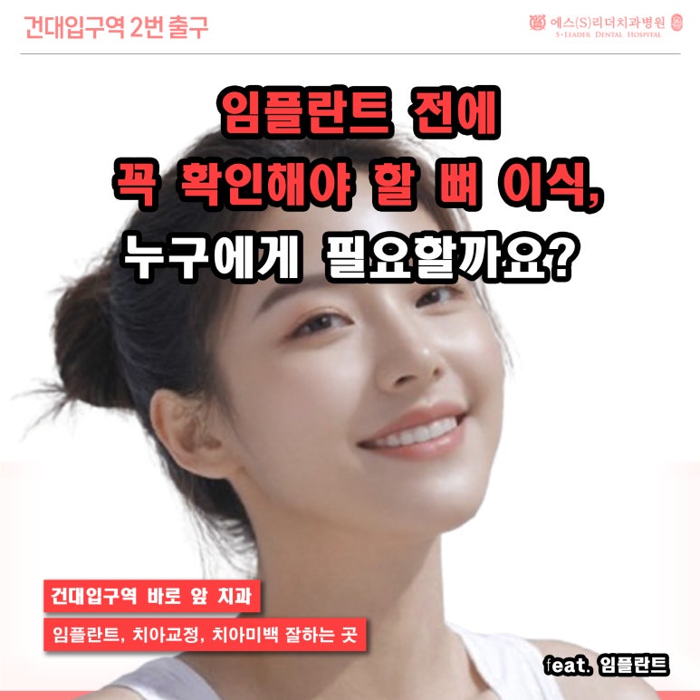 [Sagajeong Station Dental Clinic] Bone grafting that you must check before implants: Who needs it? image 1