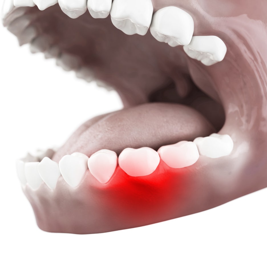 3 Important Things to Note About Chronic and Acute Periodontitis image 4