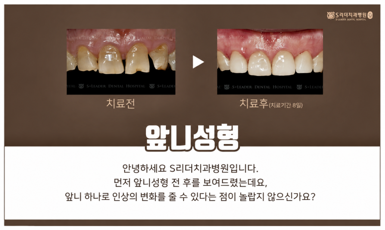 구의동치과|라미네이트 후 착색이 생길 수 있을까요? 관련 이미지 6