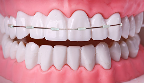[Seoul Orthodontic Dental Clinic] Everything About Orthodontic Appliances! Features by Type and Selection Guide image 6