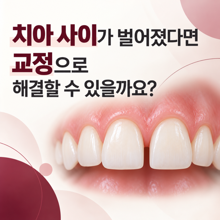 건대역치아교정, 치아 사이가 벌어졌다면 교정으로 해결할 수 있을까요? 관련 이미지 1