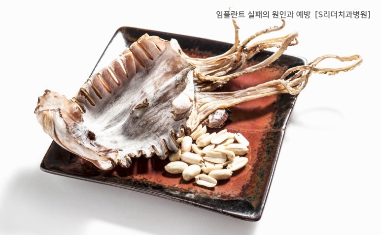 임플란트실패의 원인과 실패를 예방하는 방법은? 관련 이미지 6