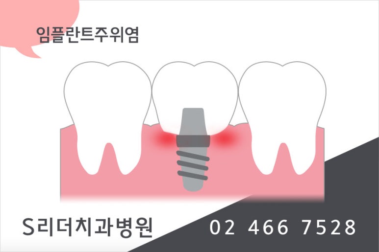 건대임플란트가 궁금해~ 관련 이미지 5