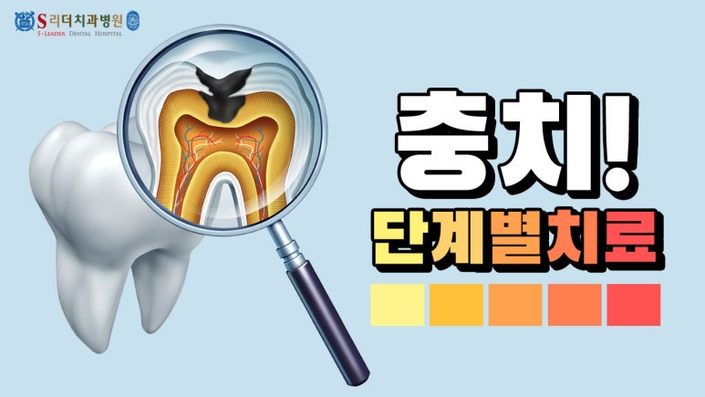 송정동치과, 충치 단계별 치료 왜 이렇게 달라질까? 관련 이미지 2