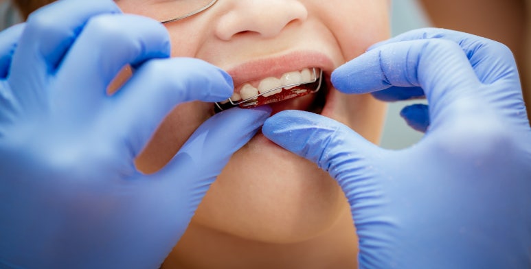 Guwi Station Dental Clinic: After Orthodontics, How Long Should You Wear a Retainer? image 5