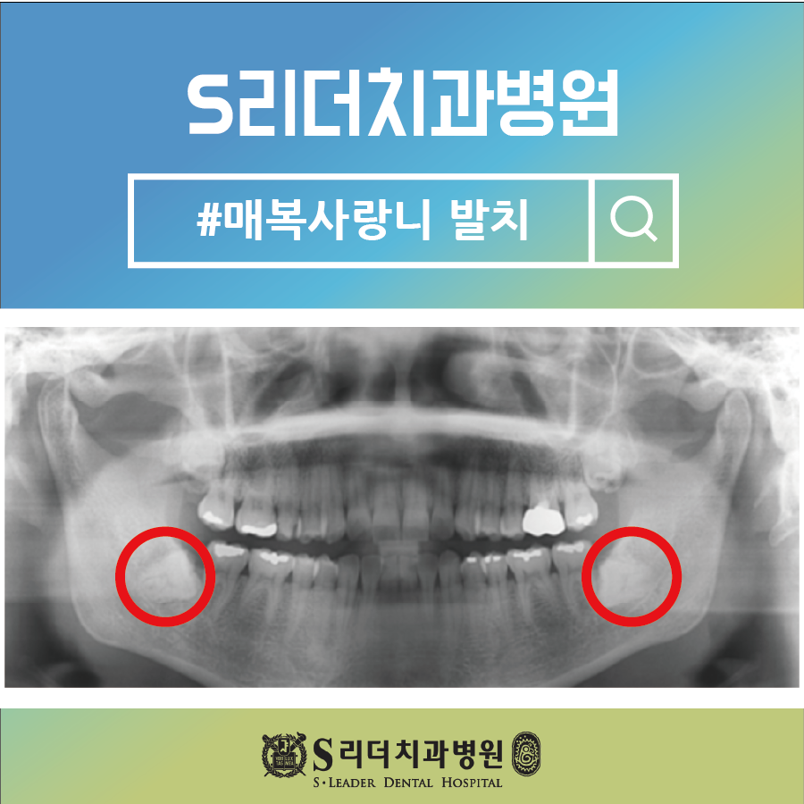 서울야간치과 사랑니발치는 에스리더치과병원 관련 이미지 16