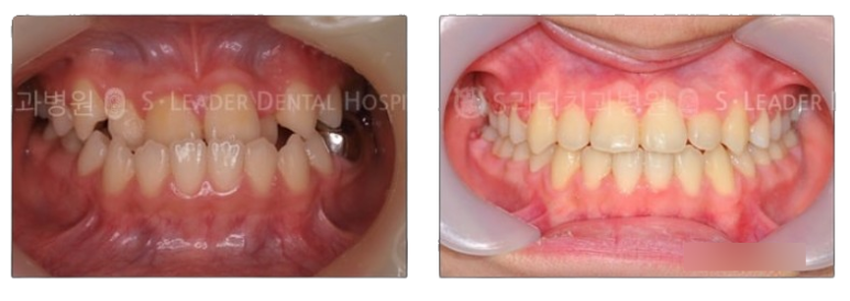 [Mangu-dong Dental Clinic] Cases Requiring Orthodontic Treatment: Protruding Jaw or Crossbite image 3