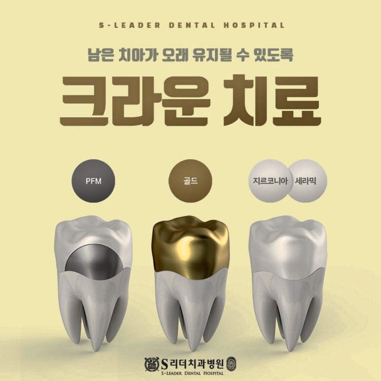 송정동치과 신경치료 후 크라운 꼭 해야 하나요? 이유까지 정리 관련 이미지 5