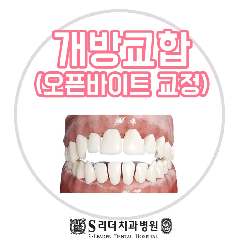 면목동치과 개방교합교정 오픈바이트 서울치아교정은 어디 관련 이미지 1