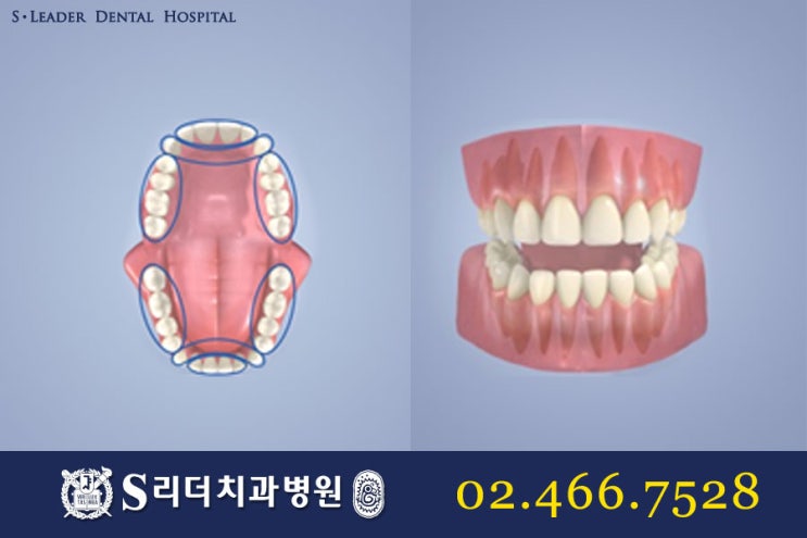앞니임플란트 몇개를심어요? 관련 이미지 3