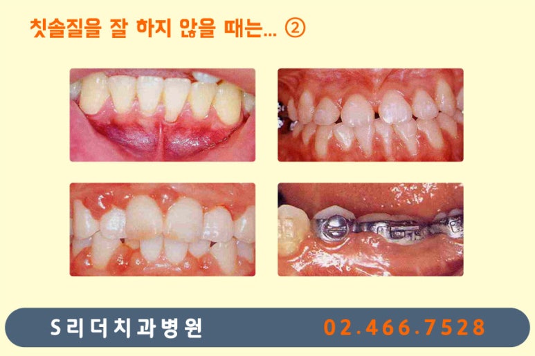 광진구교정치과 치아교정 잘 되기 위한 또하나의 방법? 관련 이미지 4