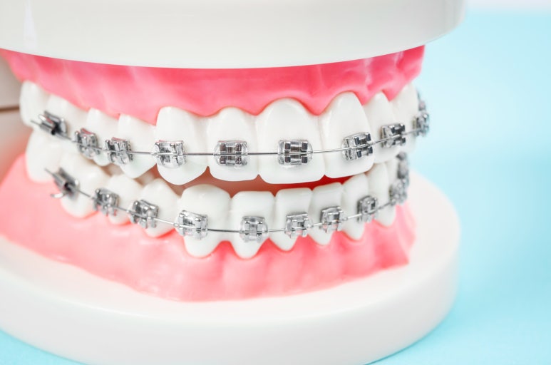 Jungnang-gu Dental Clinic: Do You Really Need “Re-orthodontic Treatment” After Finally Completing Your Braces? image 3