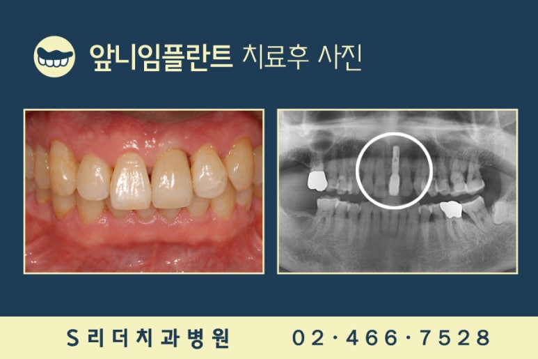 앞니임플란트 2개로 6개치아 완성 관련 이미지 8