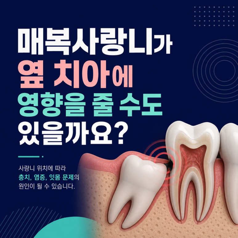 건대입구치과, 매복 사랑니가 옆 치아에 영향을 줄 수도 있을까요? 관련 이미지 1