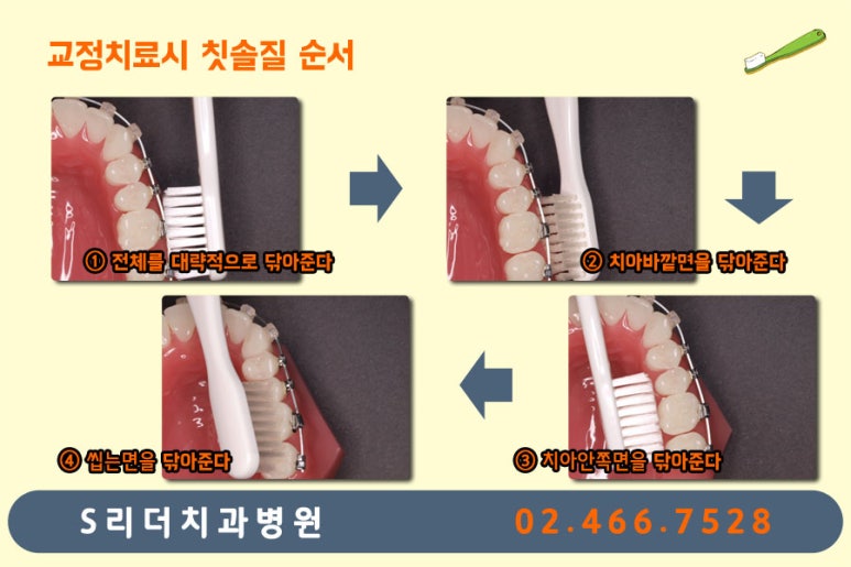 광진구교정치과 치아교정 잘 되기 위한 또하나의 방법? 관련 이미지 6