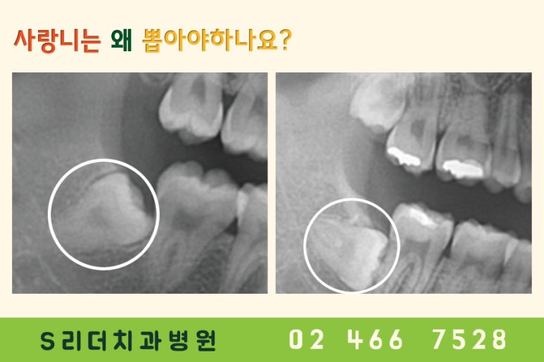 건대치과 사랑니는 왜 나올까? 관련 이미지 2