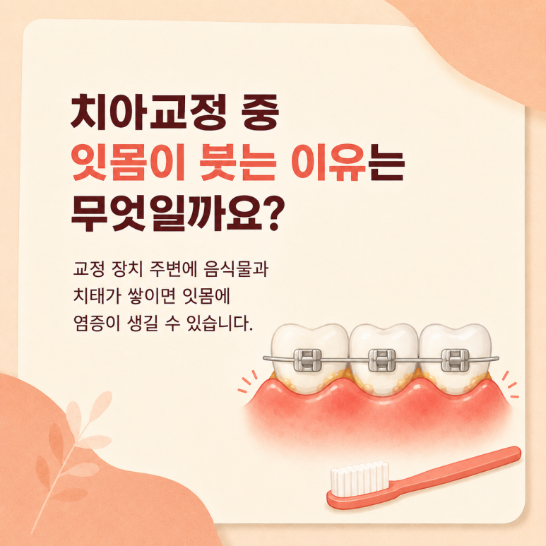 Geondae Dental Clinic: Why Do Gums Swell and Bleed During Orthodontic Treatment? image 2