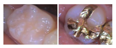 Gwangjin-gu Dental Clinic: Missing the Timing for Cavity Treatment Can Be Serious | Check the Changes by Stage image 4