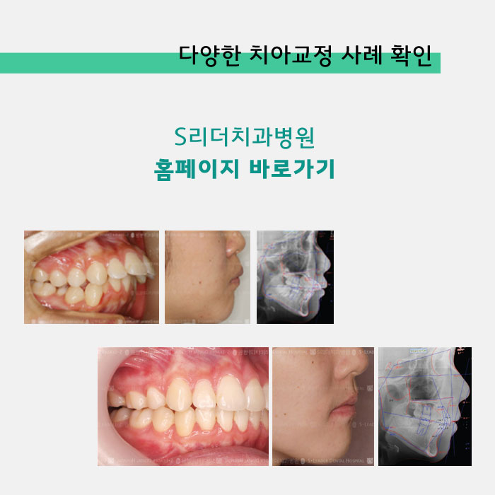 군자치과 성인치아교정 늦지 않은 이유! 관련 이미지 5