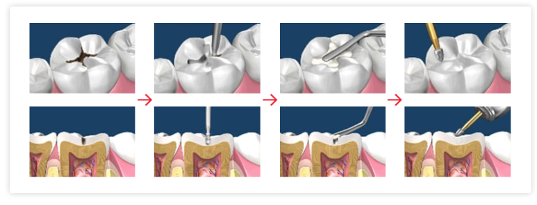 Sanggye-dong Dental Clinic: Step-by-Step Process of Cavity Treatment and Why Treatment Differs image 6