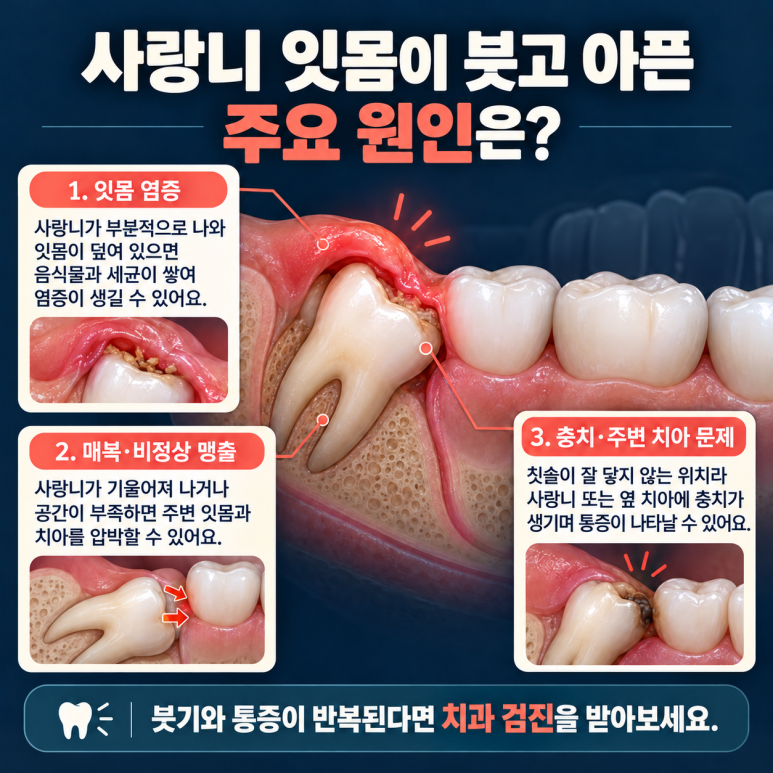 구의동치과, 사랑니 잇몸이 붓고 아프다면? 원인과 대처 방법 관련 이미지 2