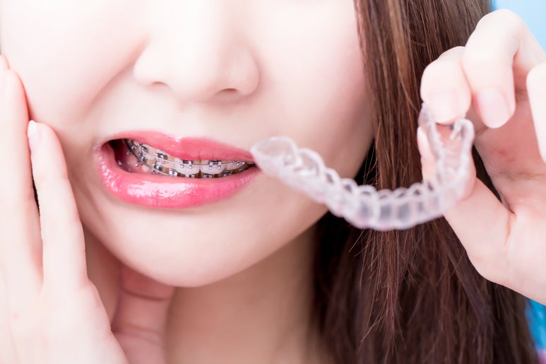 The Golden Time for Adolescent Orthodontic Treatment: Criteria Explained by a Seoul Orthodontic Dental Clinic Recommendation image 6