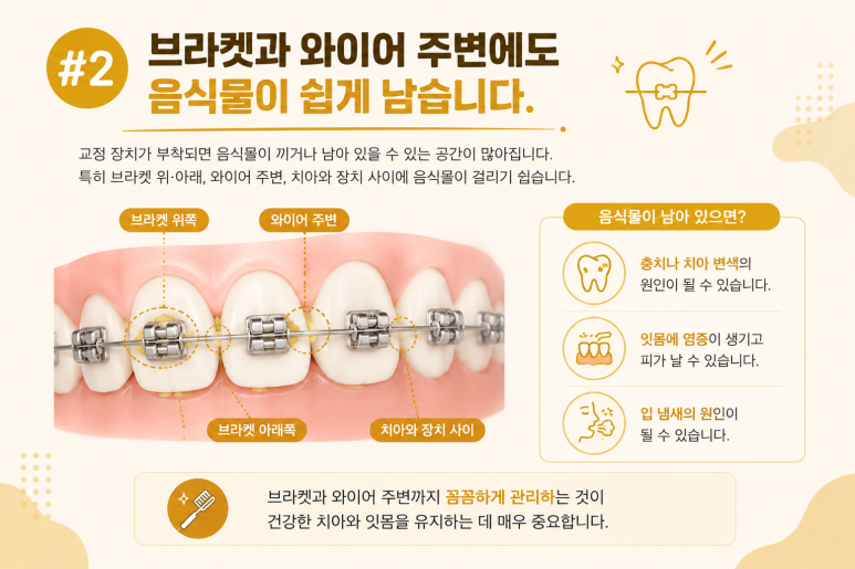 Mangu-dong Dental Clinic: Why Food Keeps Getting Stuck Between Your Teeth During Orthodontic Treatment and How to Manage It image 4