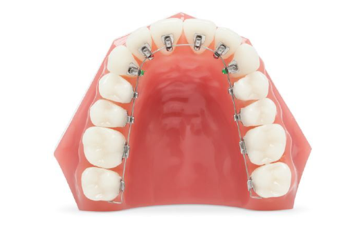 [Seoul Orthodontic Dental Clinic] Everything About Orthodontic Appliances! Features by Type and Selection Guide image 5