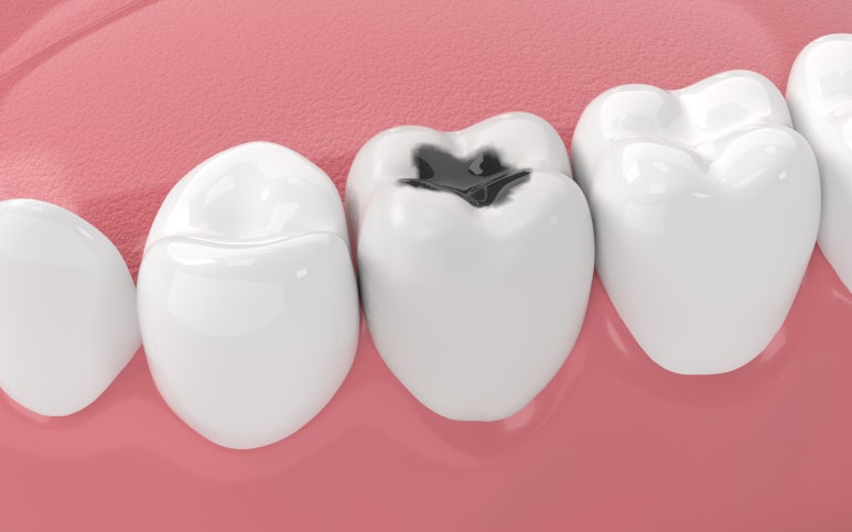 Guwi-dong Dental Clinic: Can Cavities Develop Even After Crown Treatment? image 2