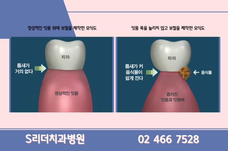 광진구치과 임플란트 단점정리 관련 이미지 10