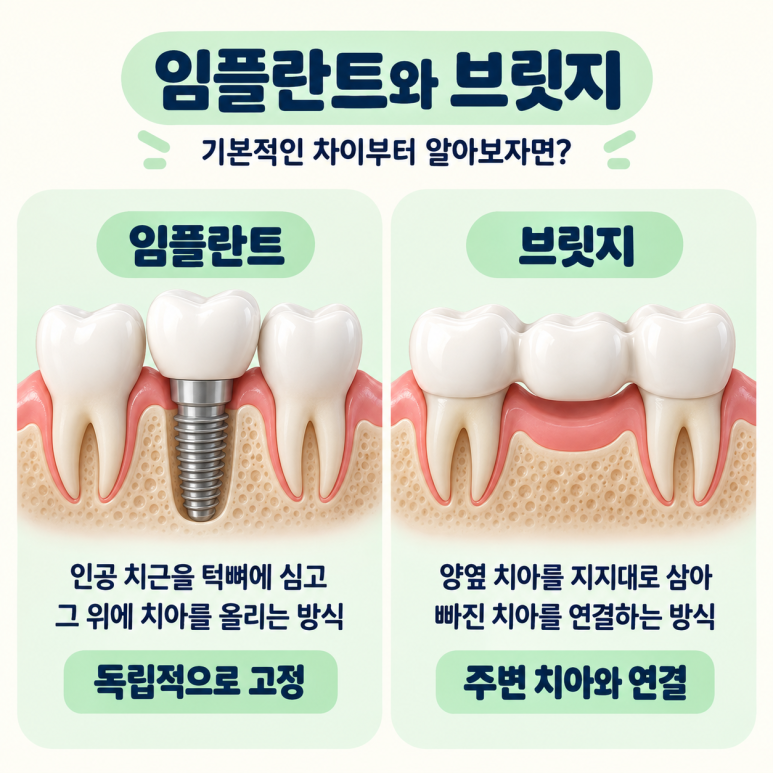 광진구임플란트와 브릿지 차이, 어떤 치료 방법이 나에게 맞을까? 관련 이미지 2