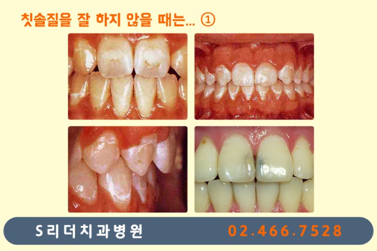 광진구교정치과 치아교정 잘 되기 위한 또하나의 방법? 관련 이미지 3