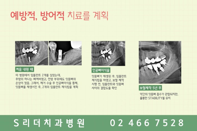 어금니임플란트 왜자꾸반복될까? 관련 이미지 7
