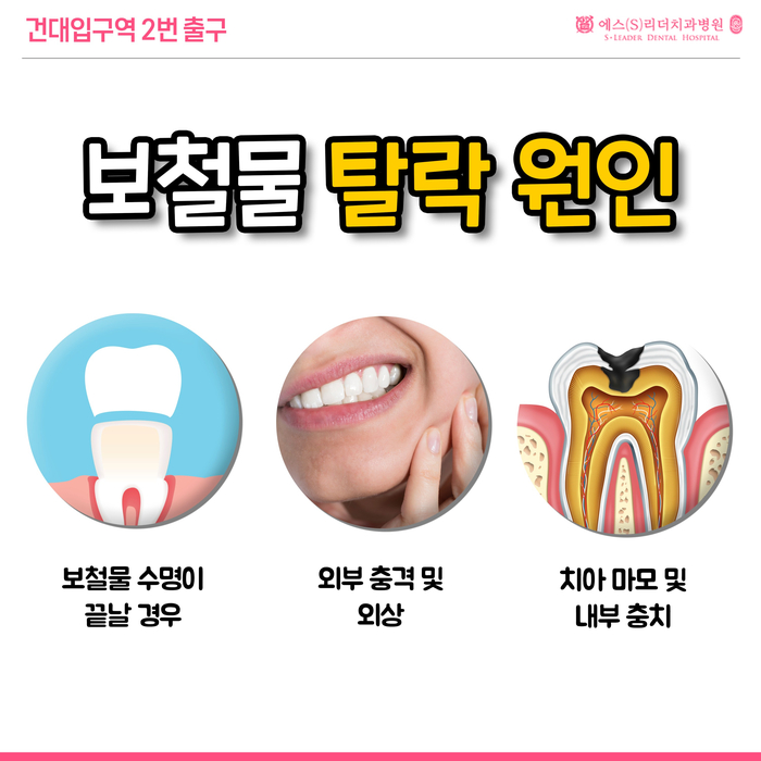 성동구치과 보철물탈락원인 대처법 에스리더치과병원에서! 관련 이미지 2