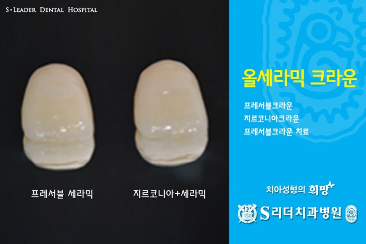 건대치과 치아성형 잘하는 곳 궁금해? 관련 이미지 7