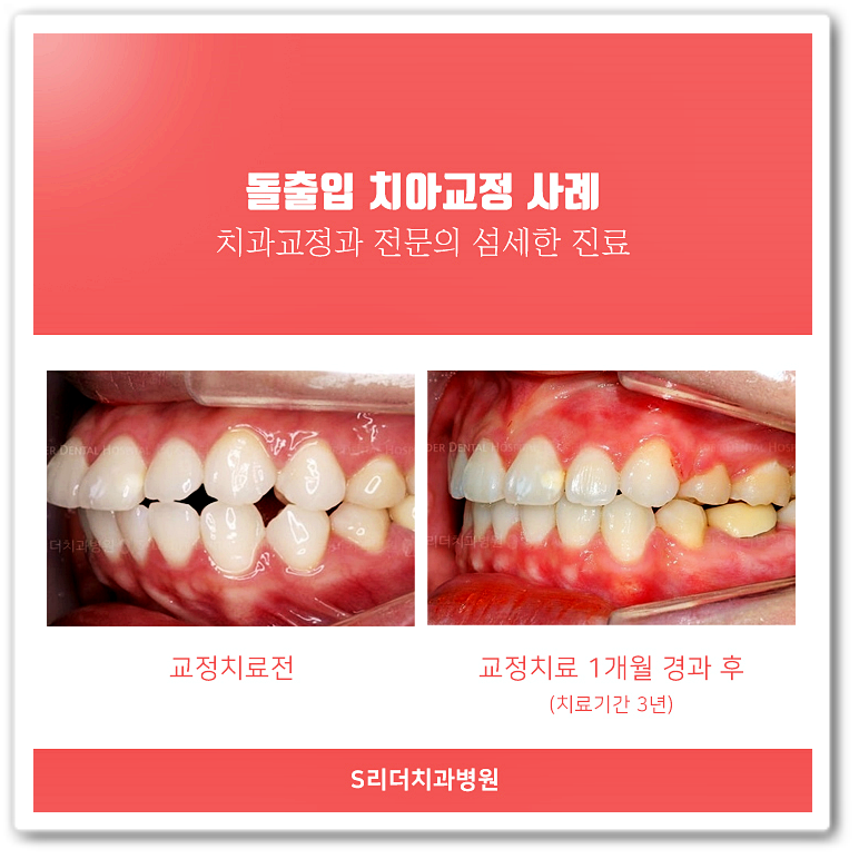 건대치과(7인의 협동진료, 양심적 성공적)건대교정치과 세밀한진료를 진행합니다! 관련 이미지 8