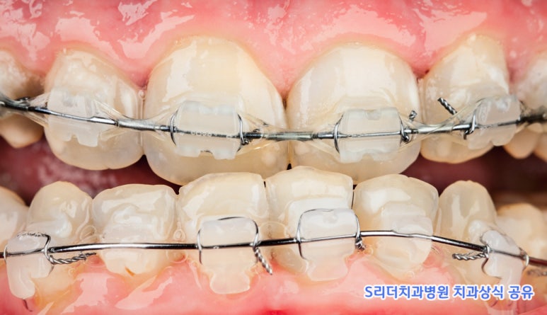 잇몸질환의 원인 중 구조적인 원인은? 관련 이미지 3