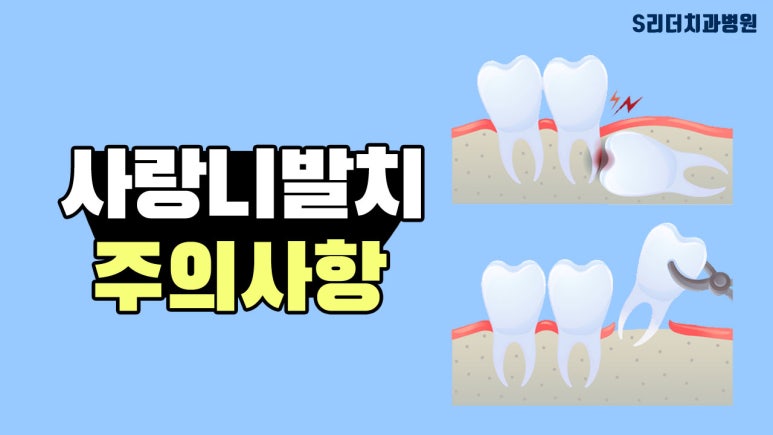 군자역치과 매복 사랑니 방치하면 생기는 문제, 옆 치아 충치와 잇몸 손상 관련 이미지 8