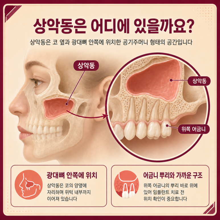 송정동치과 잇몸뼈가 부족하면 상악동거상술을 꼭 해야 할까요? 관련 이미지 2