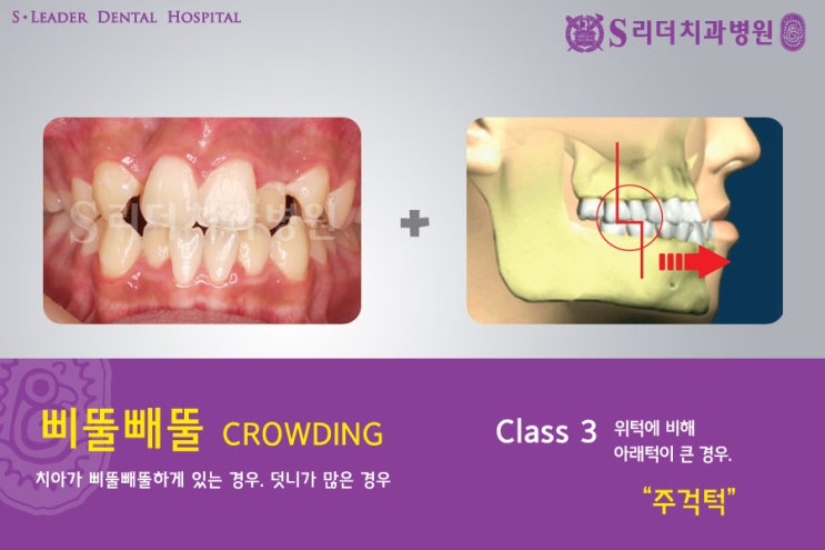 건대교정치과 내 마음에 쏙 드는 교정치과 어때요? 관련 이미지 6
