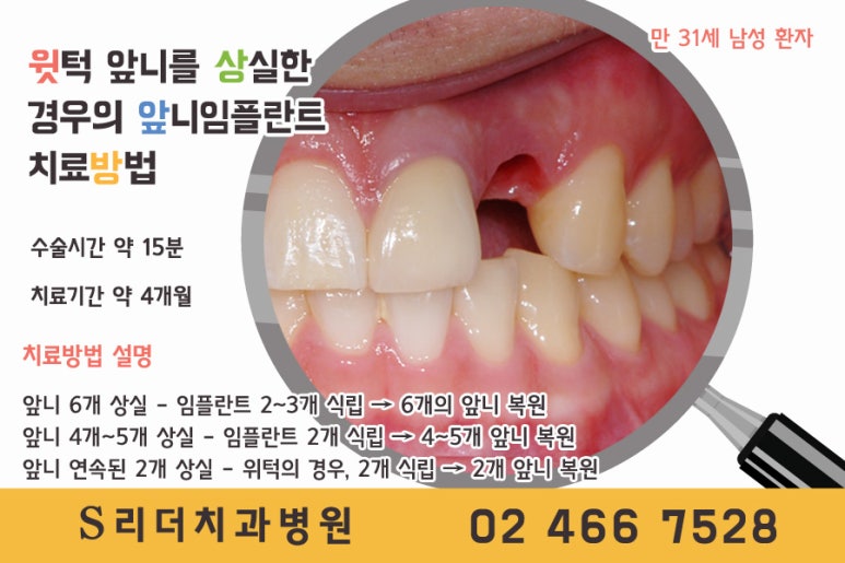 앞니임플란트 몇개를 심어야할까? 관련 이미지 3
