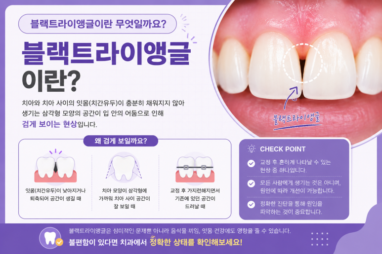 Konkuk University Orthodontics: Do Your Teeth Look Spaced Apart? It Could Be Caused by Black Triangles image 2