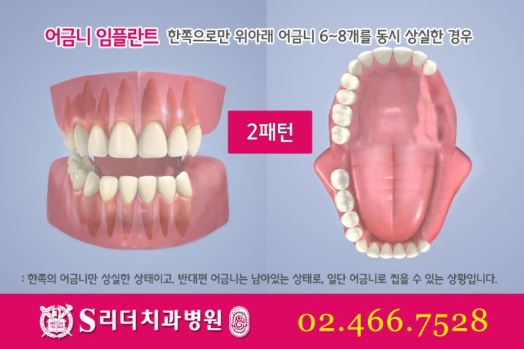 어금니임플란트 알면 좋은정보! 관련 이미지 5
