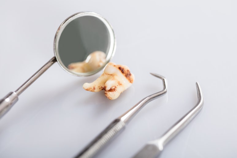 [Konkuk University Entrance Station Dental Clinic Recommendation] Impacted Wisdom Teeth: When Is the Best Time to Remove Them? image 2