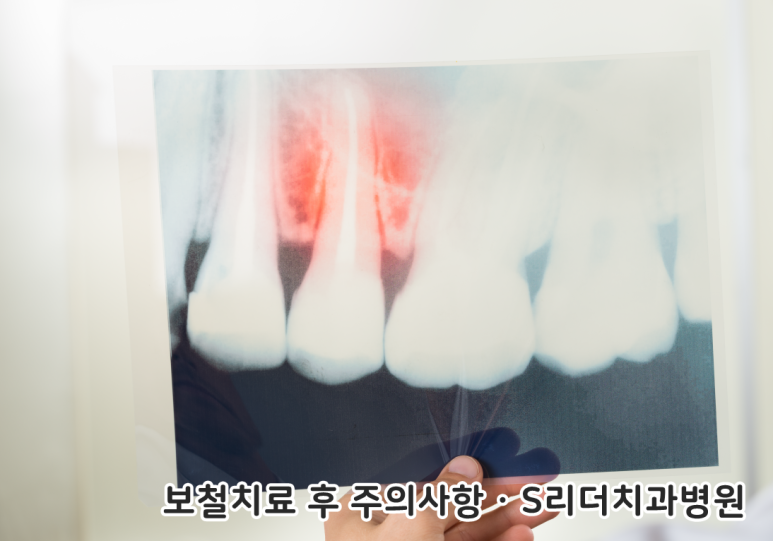 보철치료 후 주의사항 인레이부터 크라운까지 모두 알아보기 관련 이미지 2