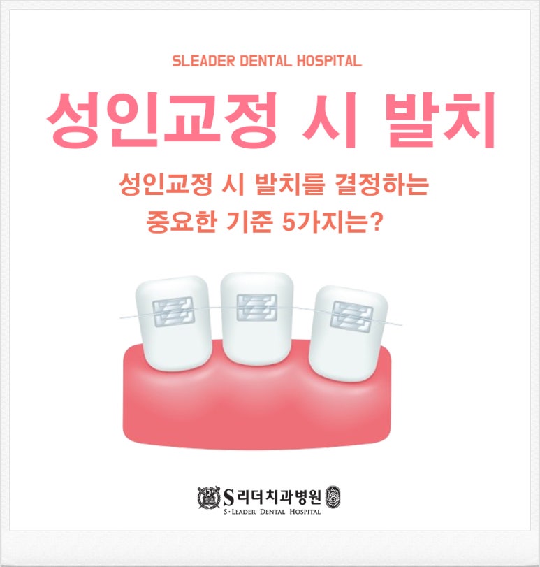 서울교정치과추천, 성인 교정 시 발치를 결정하는 중요한 기준 5가지는? 관련 이미지 1
